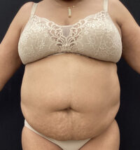 Liposuction