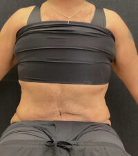 Tummy Tuck