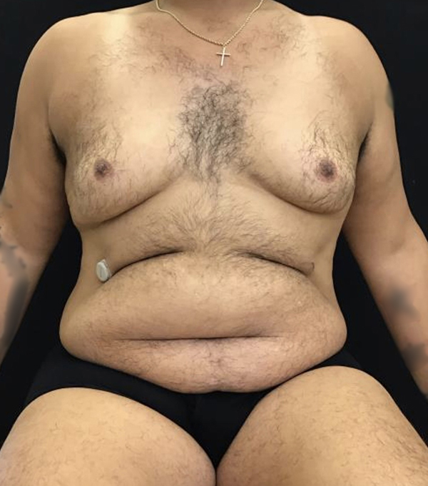 Tummy Tuck