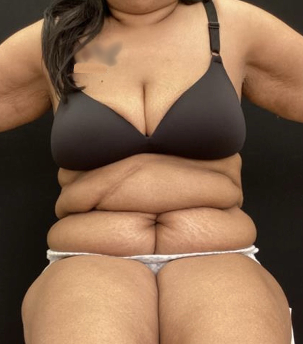 Tummy Tuck