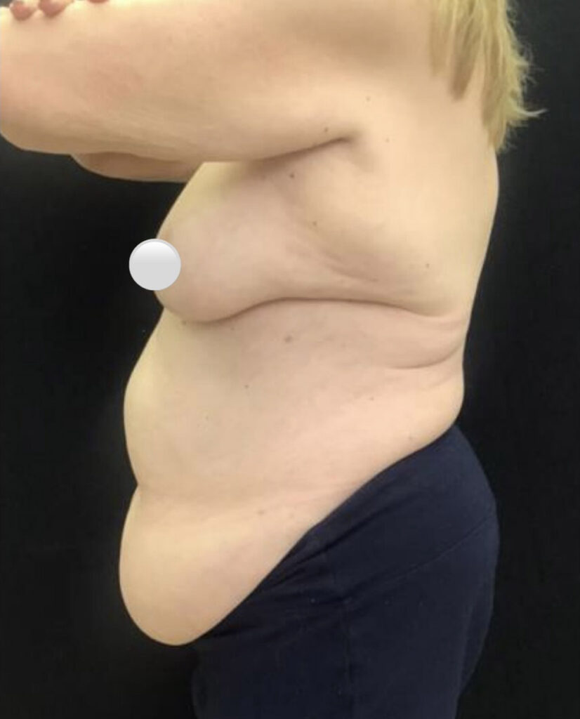 Tummy Tuck