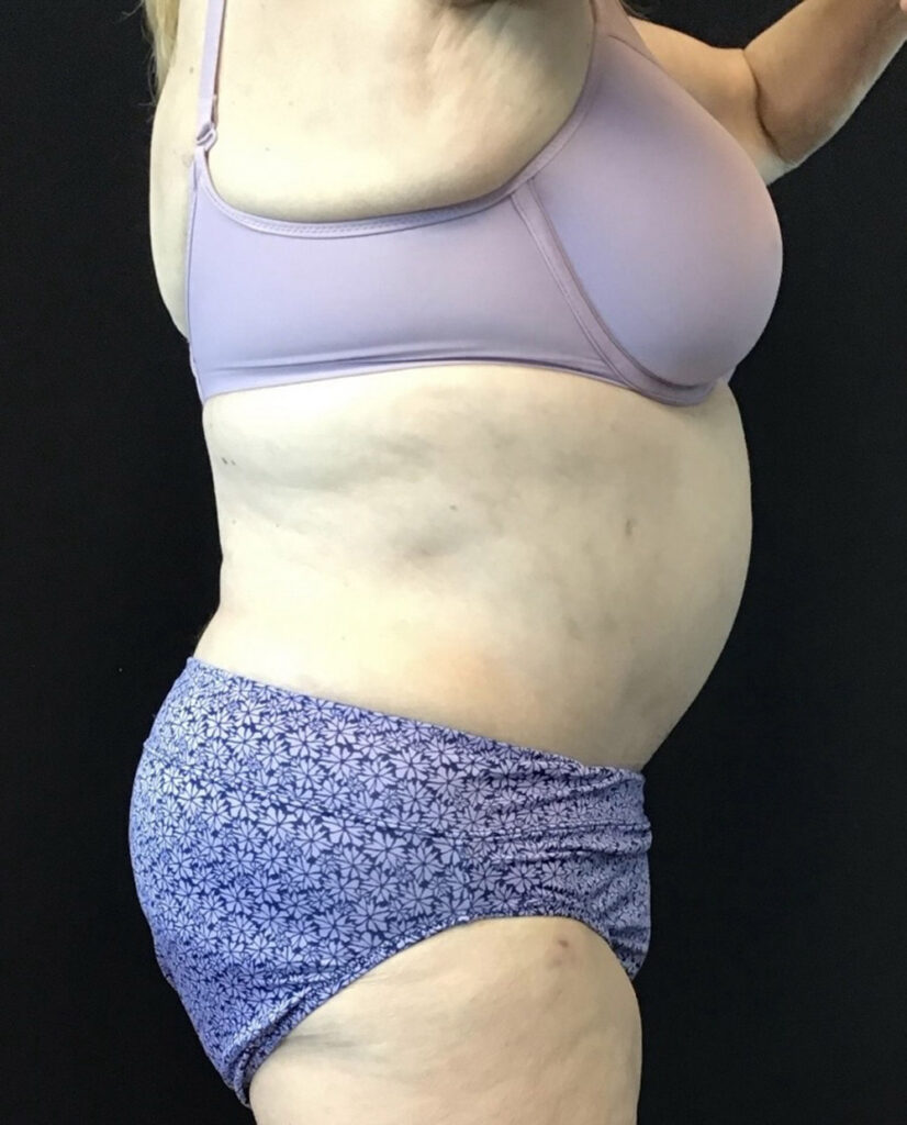 Tummy Tuck