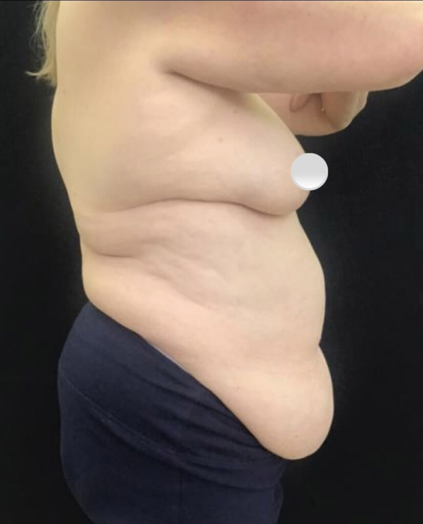 Tummy Tuck