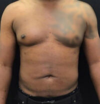Liposuction