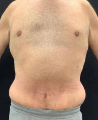Tummy Tuck