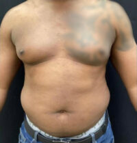 Liposuction