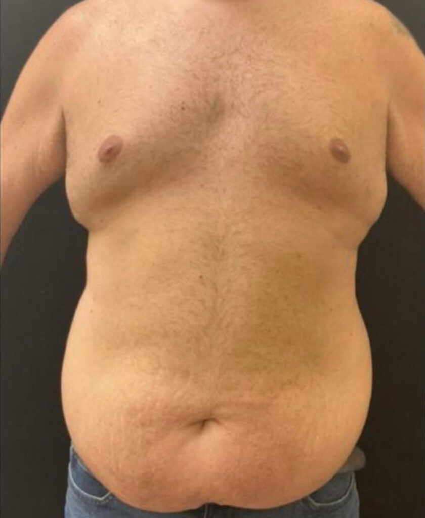 Tummy Tuck