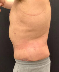Tummy Tuck