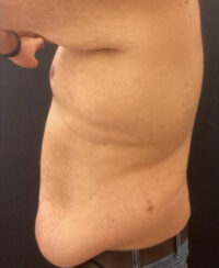 Tummy Tuck