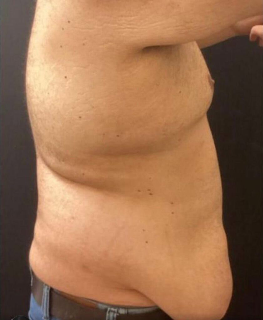 Tummy Tuck