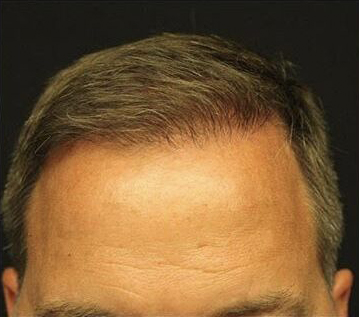 NeoGraft