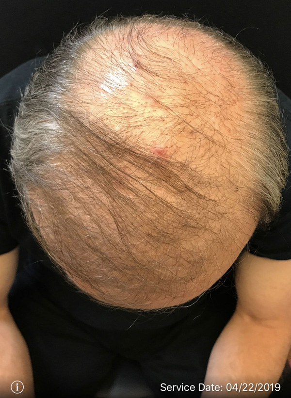 NeoGraft