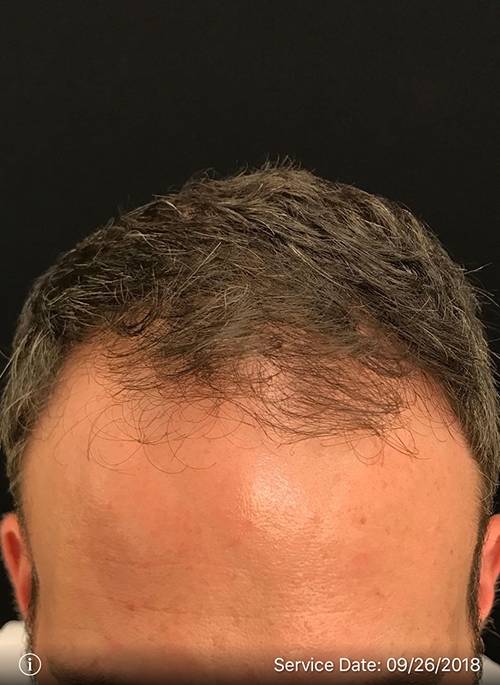 NeoGraft