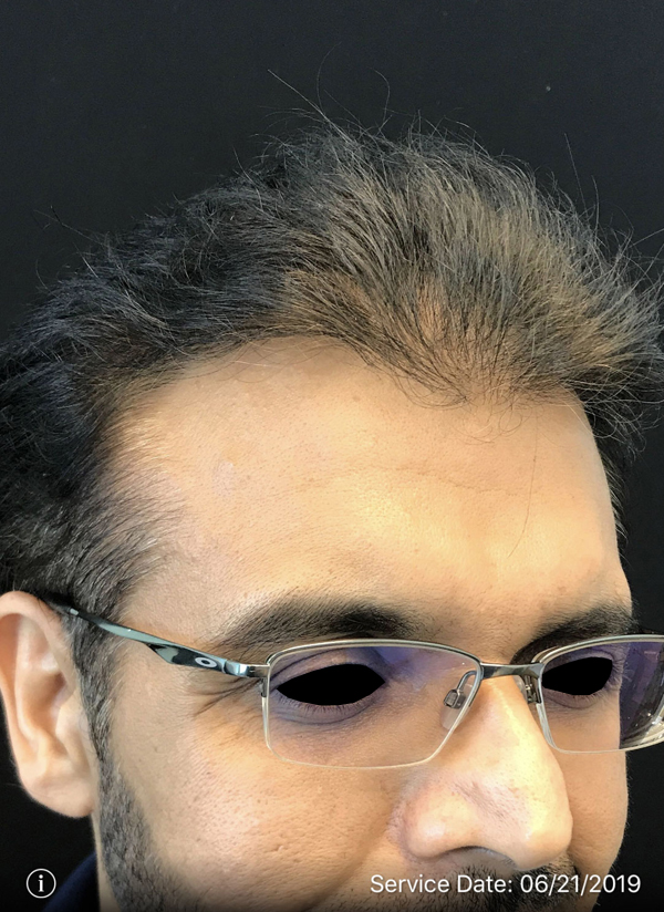 NeoGraft