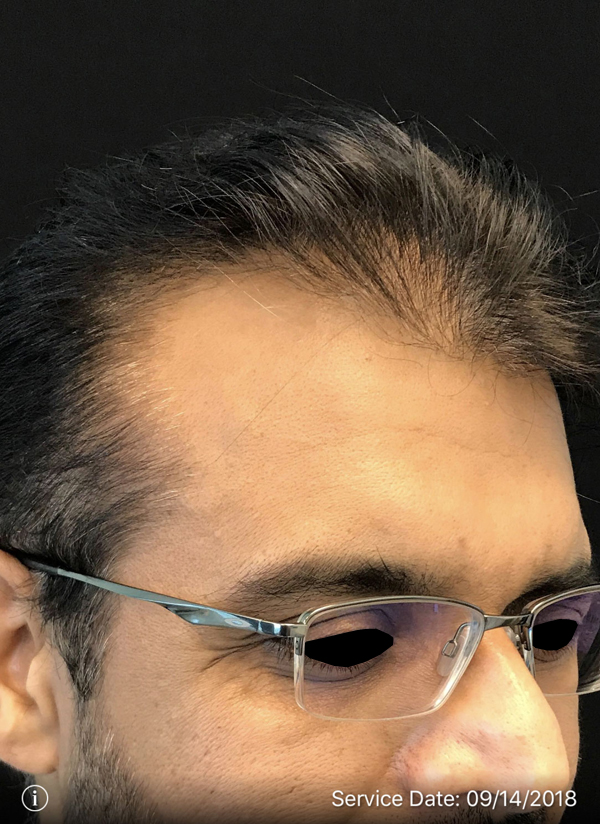 NeoGraft