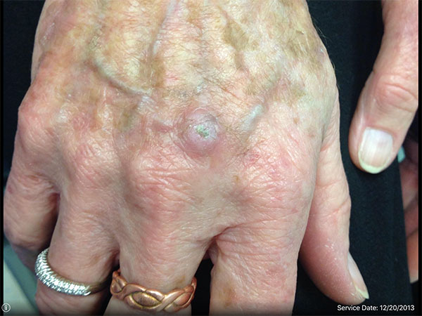 Dermatologic surgery – Squamous cell carcinoma by Dr. Larry Chang