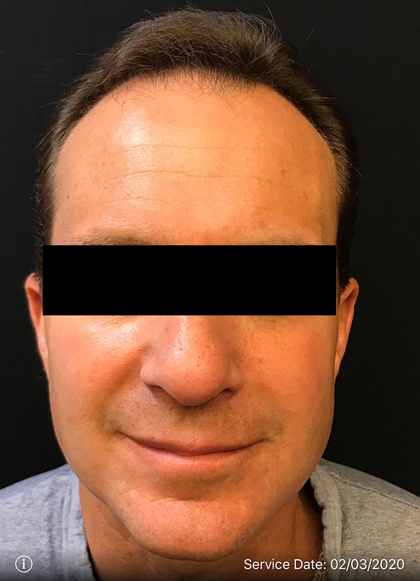 NeoGraft