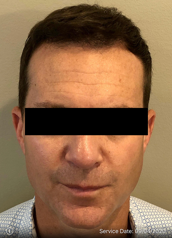 NeoGraft