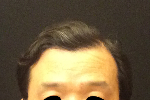 NeoGraft