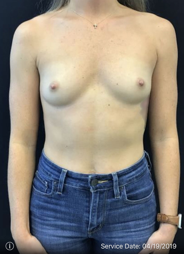 Types of breast implants