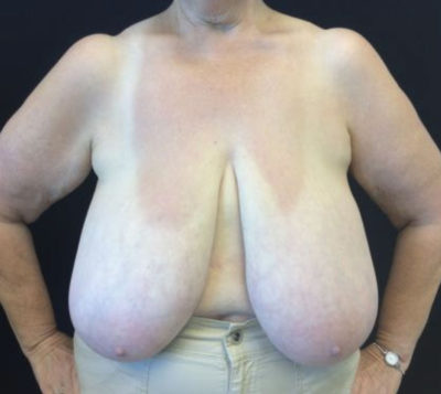 Breast Reduction Before and After