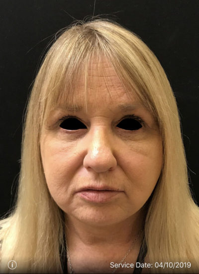 liquid facelift