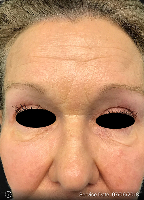 Blepharoplasty Results