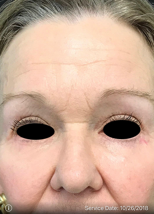 Blepharoplasty Results